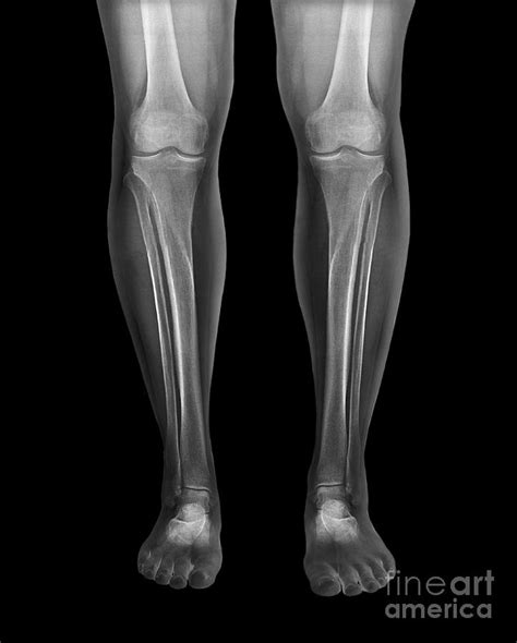 Normal Legs X Rays Photograph By Zephyr