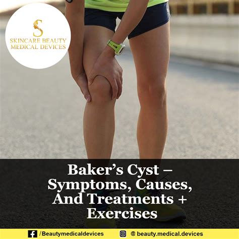 Bakers Cyst Symptoms Causes And Treatments Exercises