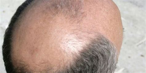 Early Balding May Be Linked With Lou Gehrigs Disease Fox News