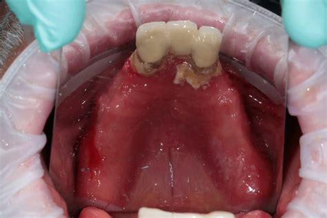 Dental Implants🦷price In Dnipro ᐉ Dental Implantation ᐉ Amel Dental Clinic