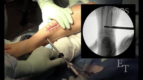 Aaos Ovt Single Incision Approach To Tibial And Fibular Osteotomies