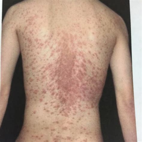 Aug 05, 2020 · the following tips may help relieve the discomfort of pityriasis rosea: Podcast #71: Pityriasis Rosea - The Emergency Medical Minute