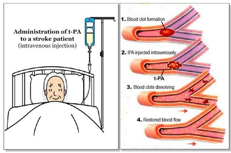 They are used in clinical medicine to treat embolic or thrombotic stroke. t-PA - a 'Magic Bullet' For Treating Stroke