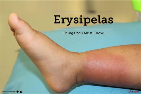 Erysipelas Things You Must Know By Dr Naik Homoeopathy Lybrate
