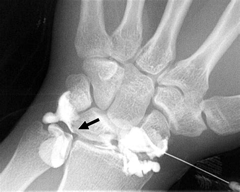 Lateral Approach For Radiocarpal Wrist Arthrography Ajr