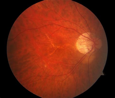 Lacquer Cracks In Pathologic Myopia Retina Image Bank