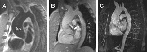 Ascending Aortic Dilatation Associated With Bicuspid Aortic Valve
