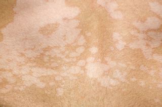 Fungal Skin Infections Back