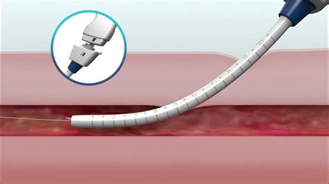 Manta Vascular Closure Device Overview Youtube