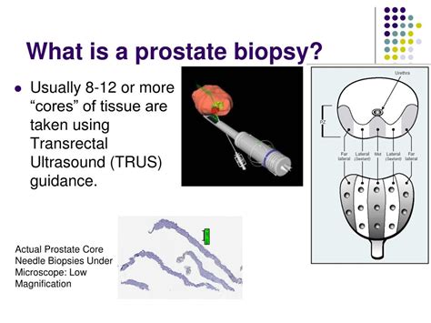 Ppt Prostate Needle Biopsy The Pitfalls And The Role Of The