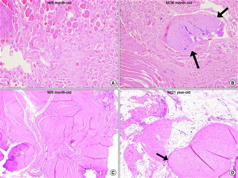 Th E Histopathological Fi Ndings Of The Sternocleidomastoid Muscle With