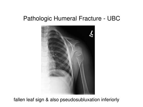PPT - Proximal Humeral Fracture in Children PowerPoint ...