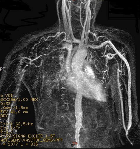 Takayasus Arteritis Wikidoc