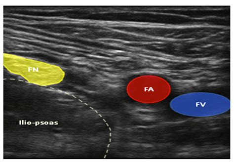 Ultrasound Guided Femoral Nerve Block Wfsa Resources The Best Porn