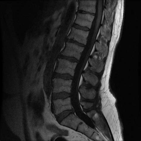 Lumbar Spine Ct Scan Purpose Procedure Risks Gambaran