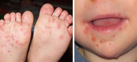 hand foot and mouth disease is sweeping across parts of the us