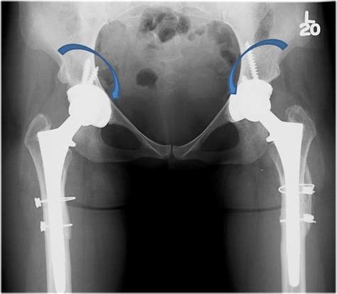 Hip Replacement St Louis Mo Periacetabular Osteotomy Pao For