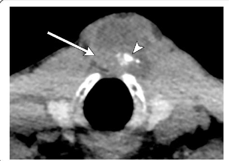 Thyroglossal Duct Cyst With Malignancy Axial Ct Image Demonstrates A