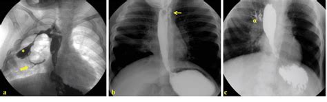 Figure 1 From Acquired Tracheoesophageal Fistula After Esophageal