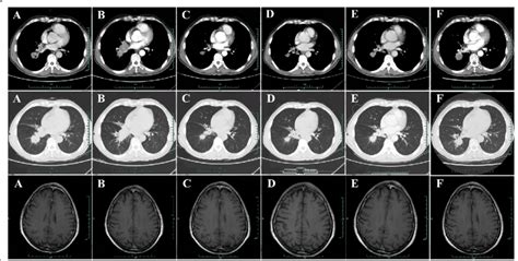 Chest Ct Scan And Brain Mri From April 2015 To February 2016 A Chest