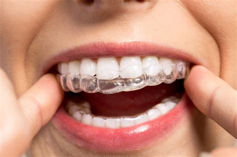 Running short on time, forgetting to do so or just assuming that since you are the only one using it, it doesn't get filthy, will be your downfall. Tips for Cleaning Your Invisalign Aligners | Bracify 3D ...