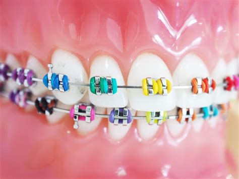 The 3 Most Common Types Of Braces The Smile Dental Lounge Dental