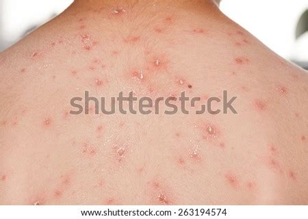 Some people have rashes, hives, blisters, and other skin symptoms that may point to a coronavirus infection. Smallpox Virus Stock Photos, Images, & Pictures | Shutterstock