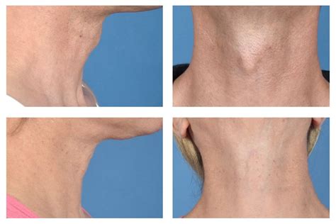 Photo Adams Apple Surgery Before And After Ucla