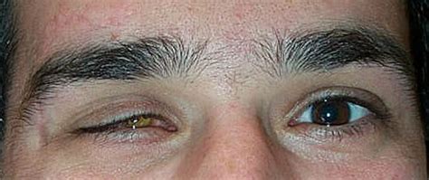 Blunt Trauma With Perforating Injury Dalpasso Protesi Oculari