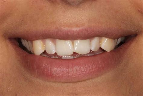 A Recent Invisalign And Composite Bonding Case From Dr Chris Beech