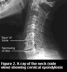 Many people have cervical spodylosis that has yet to be diagnosed. Pinoy Bone and Joint: GMA's Pain in the Neck