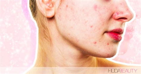 This Could Be The Reason Your Acne Wont Go Away Blog Huda Beauty