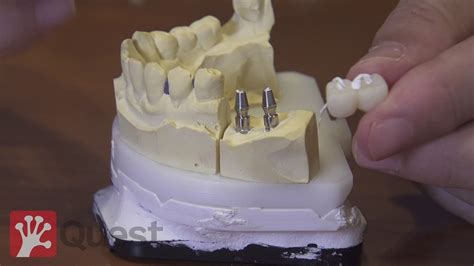 Sistema Dual De Prótesis Fija Sobre Implantes Con Clip Sobre Pilar Intermedio Fixpeek® Youtube
