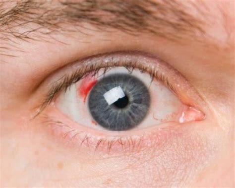 Blood Clot In The Eye And How To Get Rid Of It