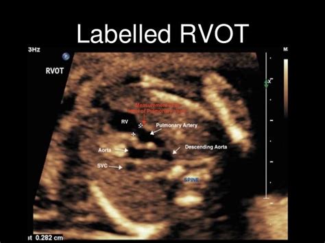 Αποτέλεσμα εικόνων για Fetal Heart Outflow Tracts Ultrasound Fetal