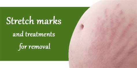 Stretch Marks And Treatments For Removal