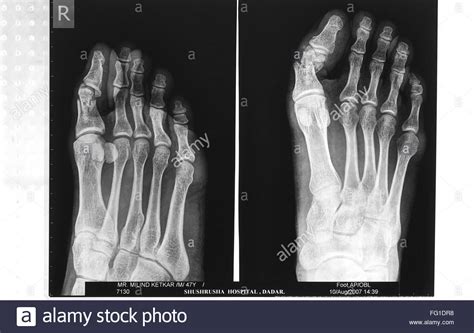 X Ray Of Fractured Right Great Toe Before Surgery Bombay Mumbai Stock