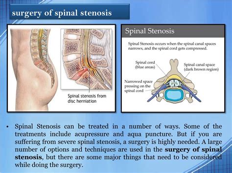 PPT Surgery For Spinal Stenosis PowerPoint Presentation Free Download ID