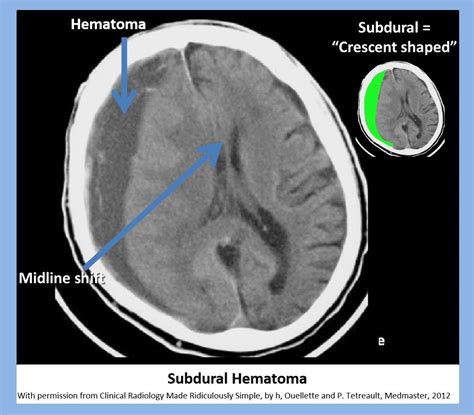 Subdurala Subdural Hematoma Neurology Radiology