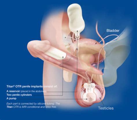 About The Internal Penile Pump Advanced Urological Care P C