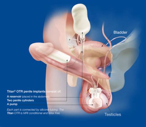 Penis Pump What Is It How To Use And What To Expect Kienitvc Ac Ke