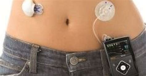 The First ‘artificial Pancreas Systems Are Coming To Market