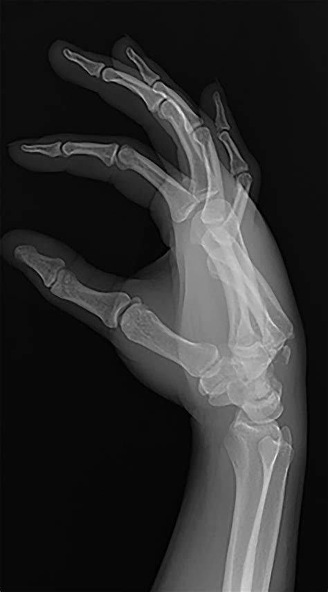 Metacarpal Fractures Hand Orthobullets