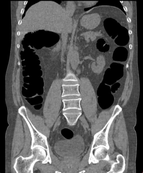 Virtual Colonoscopy Near Me Glory Lindberg