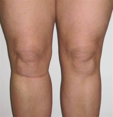 Knee Liposuction Sculpting And Refining