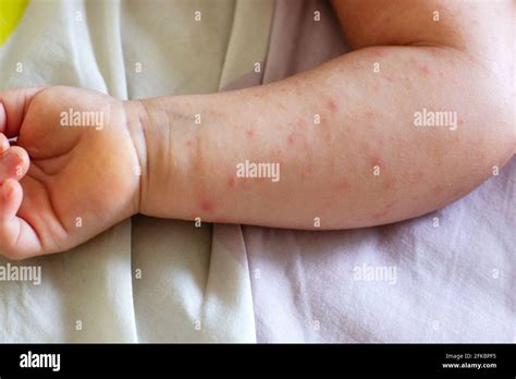 Eczema Atopic Eczema Baby Hi Res Stock Photography And Images Alamy