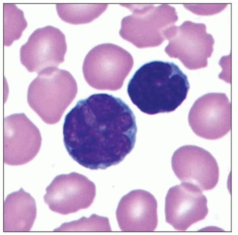 Adult T Cell Leukemialymphoma Htlv 1 Basicmedical Key