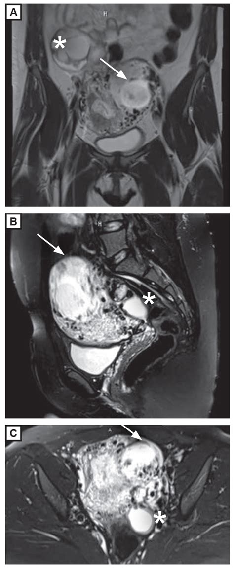 Intact Cornual Ectopic Pregnancy And Dermoid Cyst With Intraoperative