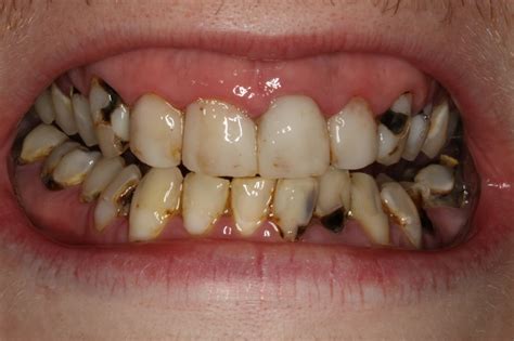 Tooth Decay Pictures Phoenix Dentist Chandler Dentist Low Prices
