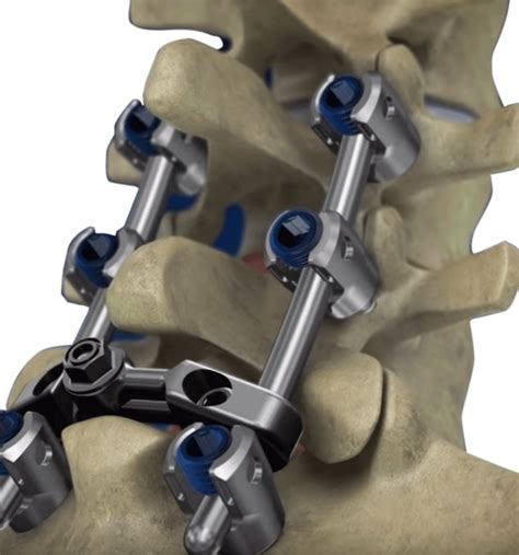 Failed Back Surgery Syndrome Back Pain Treatment